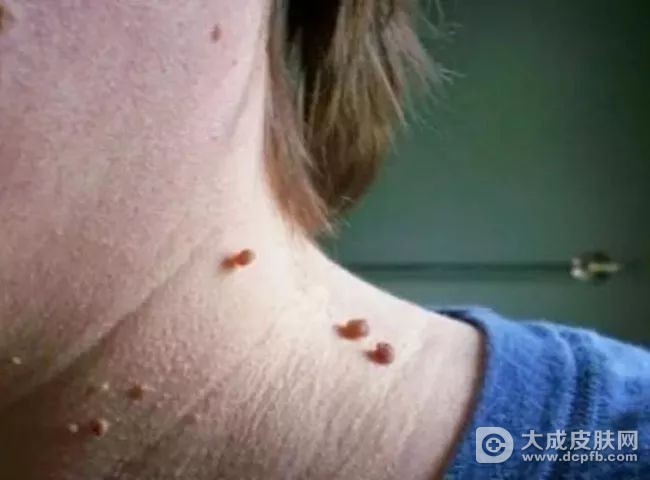 丝状疣可能会带来的伤害