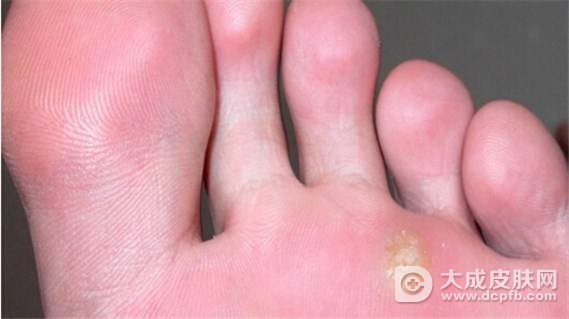 跖疣的症状及治疗方法