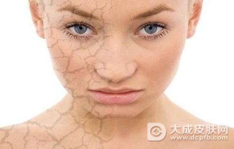 脸上干燥起干皮怎么改善