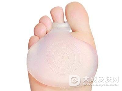 鸡眼不治会自己好吗