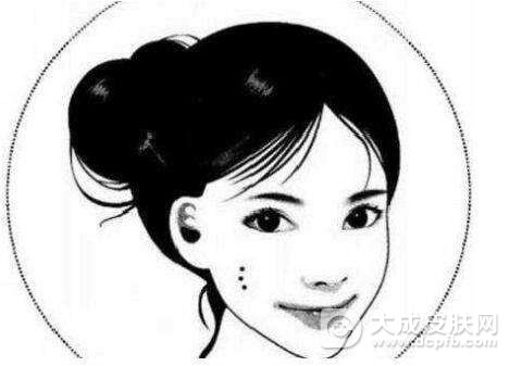 点痣