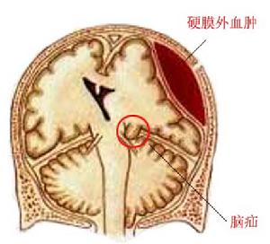 头皮下血肿图集