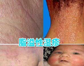 脂溢性湿疹图集
