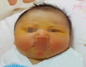 新生儿母乳喂养后出现黄疸图集