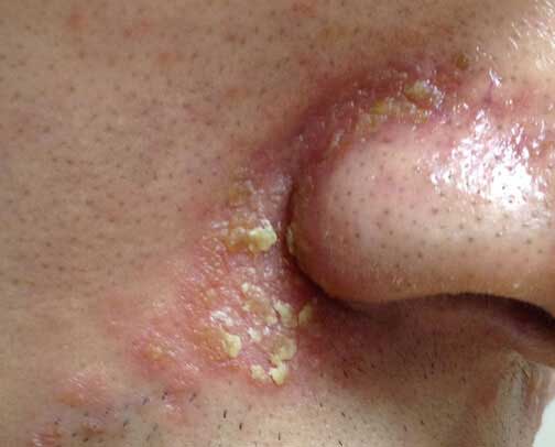 油腻性鳞屑图集