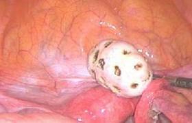 腹膜后畸胎瘤切除术