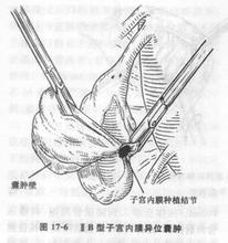 腹腔镜下直肠子宫陷凹病损切除术