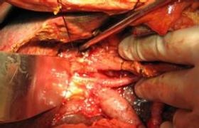胆囊癌早期根治性胆囊切除术