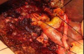 胆囊癌晚期根治性切除术
