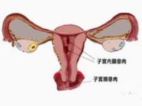腹腔镜下子宫病损激光切除术
