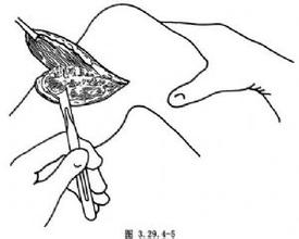 膝关节离断术