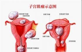 腹腔镜辅助经阴道筋膜内子宫切除术