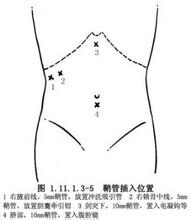 腹腔镜下肠系膜病损切除术