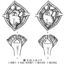 肩袖修补术