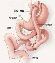 腹腔镜下可调节胃束带去除术