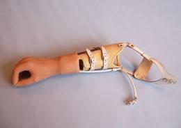 臂假肢装置植入术