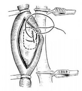 动静脉瘘经静脉修复动脉术