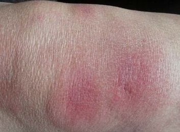 结节性红斑临床症状表现