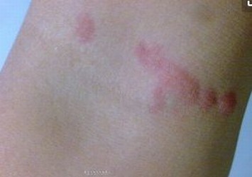 青岛结节性红斑该如何进行治疗呢