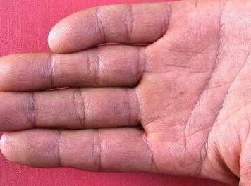 青岛四妙丹参汤治疗结节性红斑