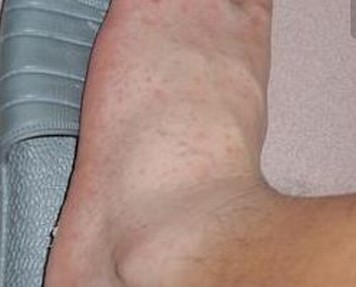 小腿出现皮疹是结节性红斑吗