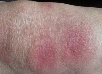 要怎样护理结节性红斑病人呢