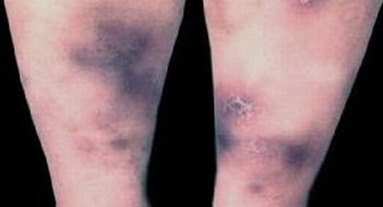 结节性红斑的病因是什么