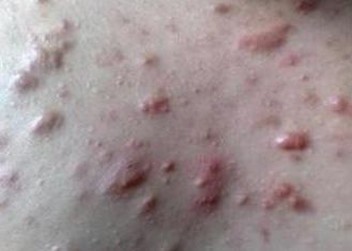 结节性红斑分布部位