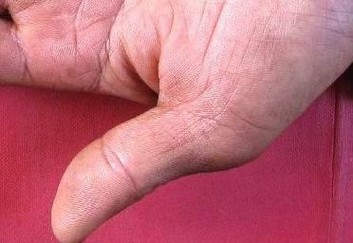 结节性红斑患者需要怎样的