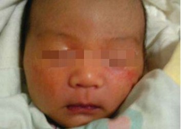 脓疱疮西医如何治疗