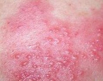 脓疱疮诊断和并发症介绍