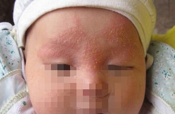 青岛脓疱疮不治疗会怎样 