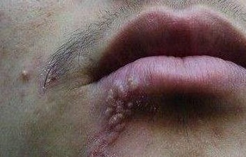 青岛脓疱疮的治疗措施