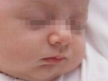 从哪些症状来诊断新生儿脓疱疮