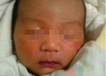 宝宝发生了脓疱疮需怎样预防 