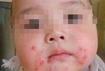 脓疱疮该如何进行家庭诊断?专家为你支招