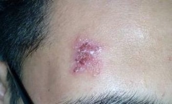 脓疱疮食疗处方 