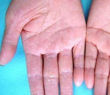 青岛手足癣治疗费用一般是多少