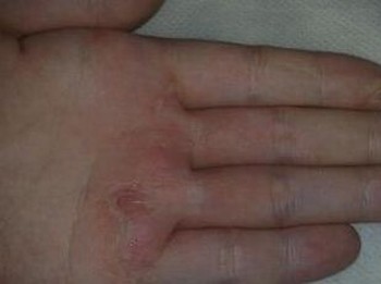 得了手足癣该怎样的预防