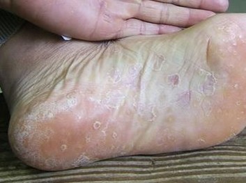 是什么造成手足癣的