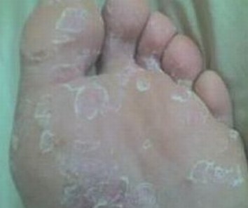 手上长小水泡是手癣吗
