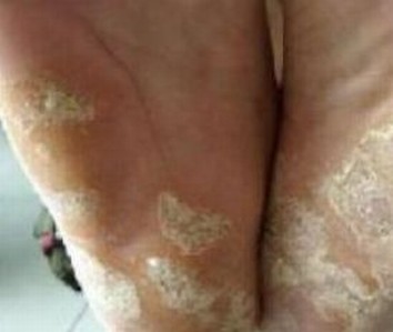 手足癣常见的症状有哪些呢