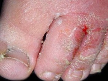 手足癣传染如何防止