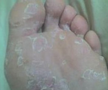 手足癣的发病特点是什么 