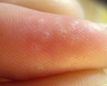 手足癣的护理及特别注意