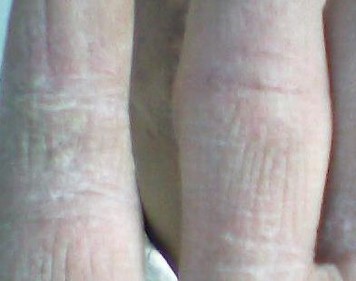 手足癣的几大症状表现