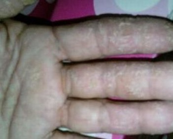 角化过度型足癣怎么办