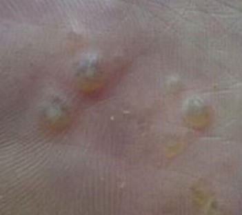 您了解手足癣症状吗