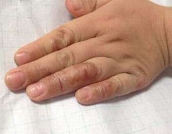 皮肤病医生解释：手足癣传染的途径 