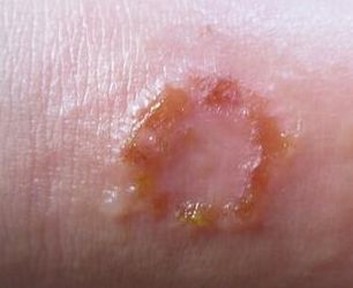 青少年早期体癣的症状